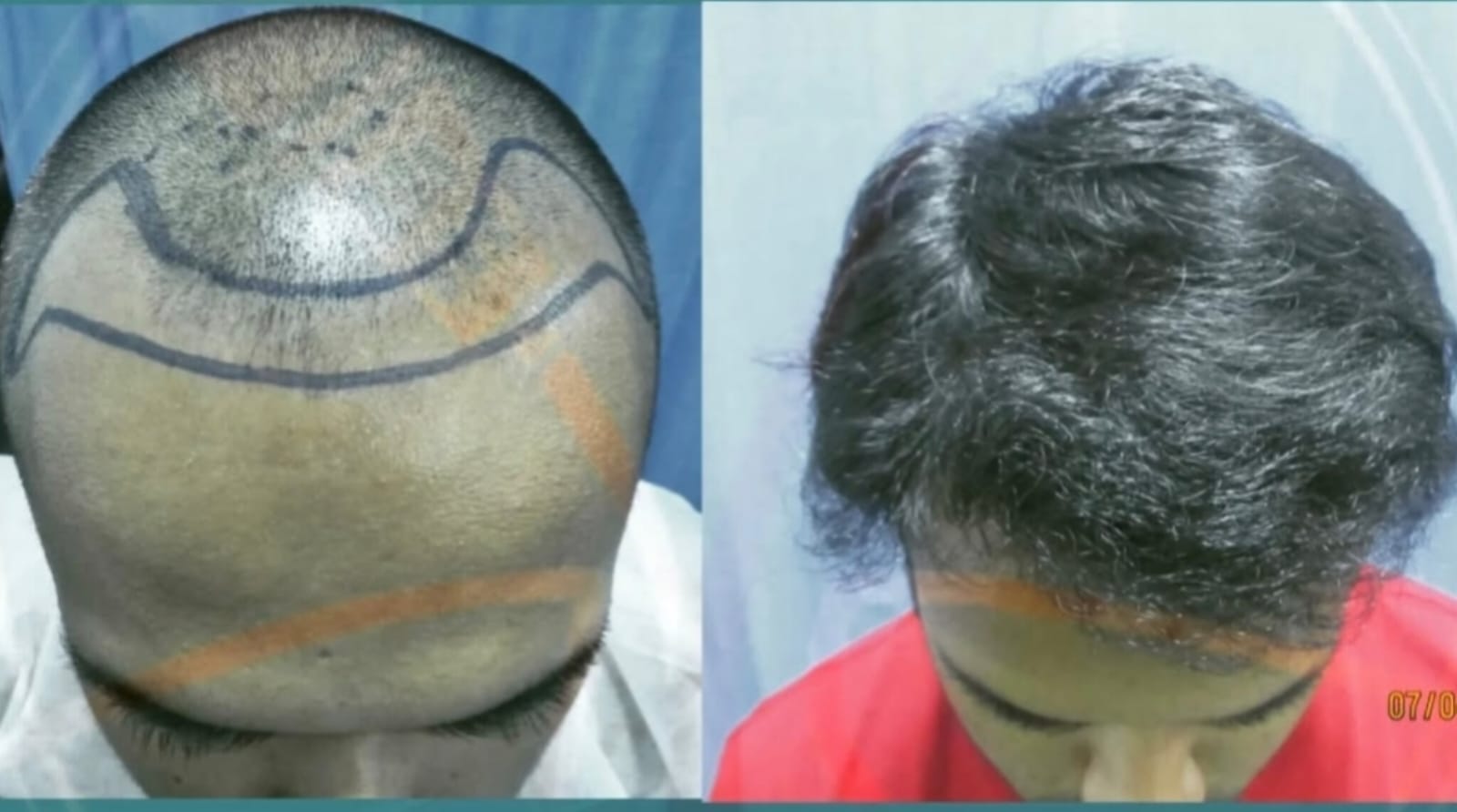 Before After
